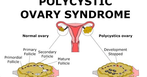 polycystic ovaries not syndrome